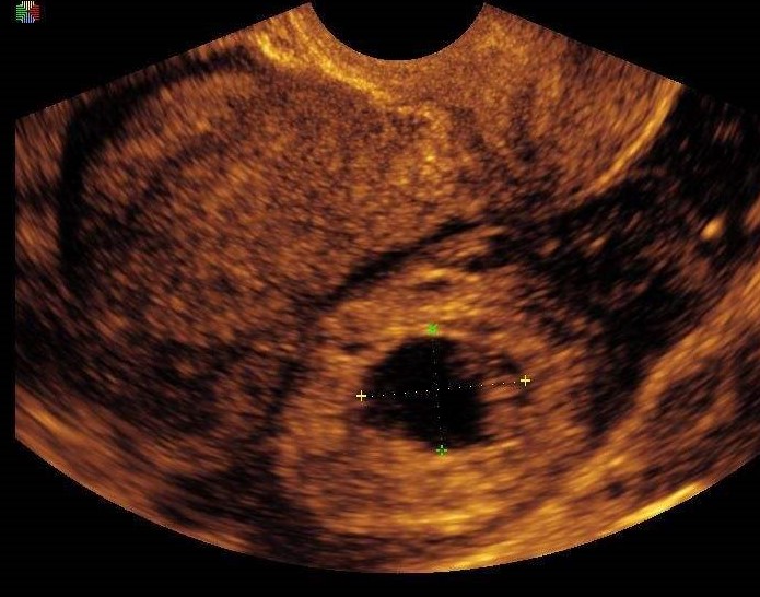 同居女友腹痛12小时死亡，宫外孕到底多可怕？医生教你3招治疗