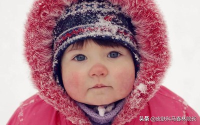 冬季皮肤干燥瘙痒起红疹怎么治,宝宝冬天皮肤干燥瘙痒怎么办