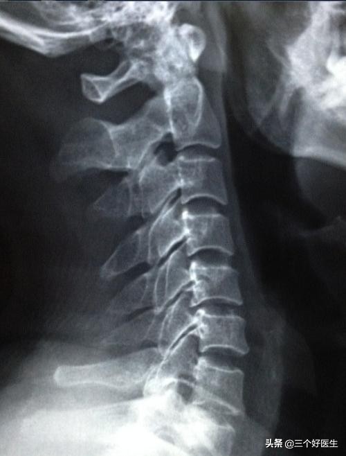 脊椎退化性改变,脊椎退化怎么治疗效果最好