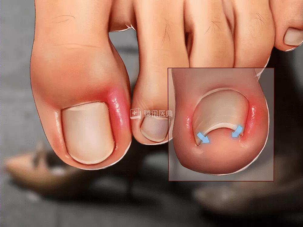 得了甲沟炎太疼了怎么办,甲沟炎疼痛难忍最有效办法