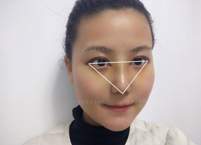 五官扁平的大饼脸,大饼脸和扁平五官怎样自救