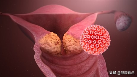 预防艾滋病50讲:性病患者最容易得艾滋病吗?女性尤其要小心