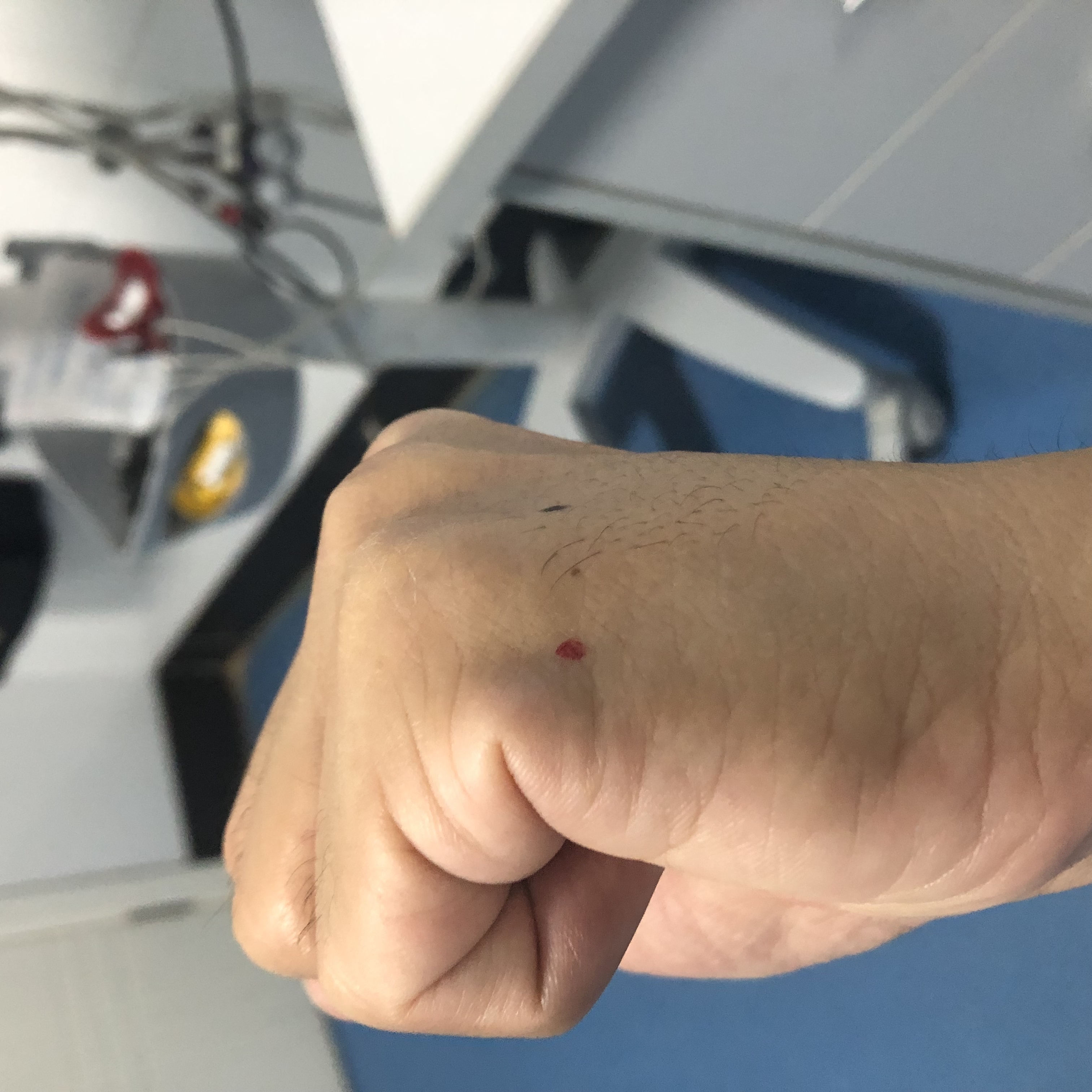 一针疗法高树中落枕,落枕针灸内关穴一针见效