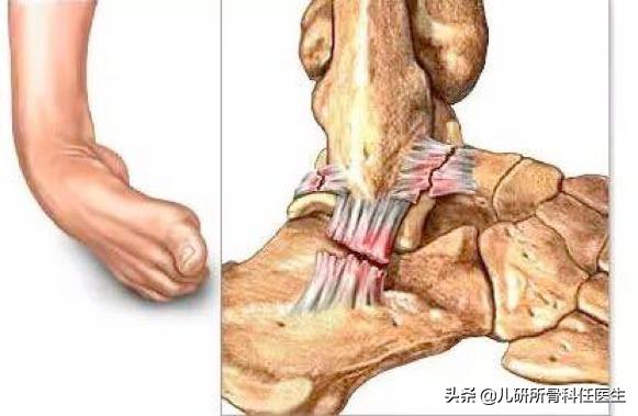 小孩脚踝麻麻的感觉怎么了,小孩常见的脚踝问题