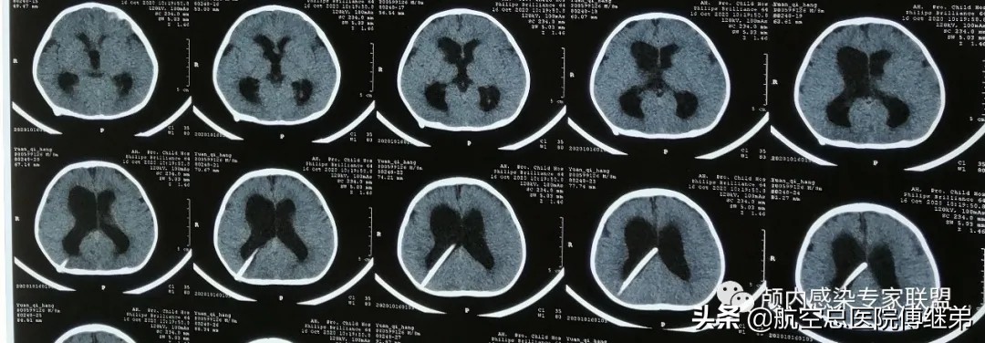 婴儿脑积水治疗方法动画演示,ommaya囊植入术是大手术吗