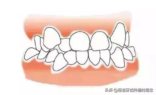 你的牙齿是否符合以上标准呢,你的牙齿够整齐吗