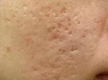 痘印很顽固怎么祛痘印,痘印祛痘药膏