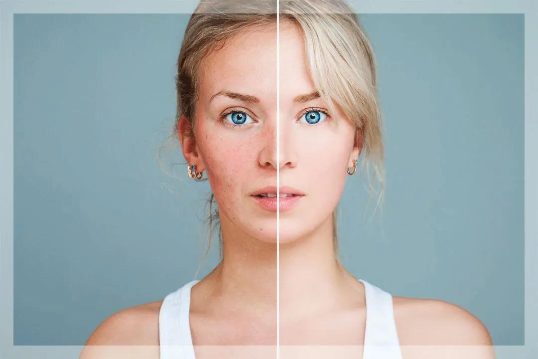 干皮反复长痘怎么调理肌肤,干皮一补水就长痘