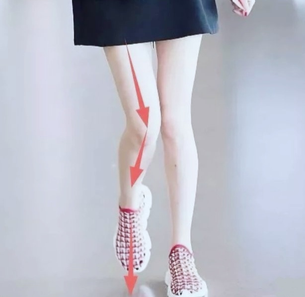 跑步时x型腿怎么矫正,x型腿跑步膝盖疼怎么办