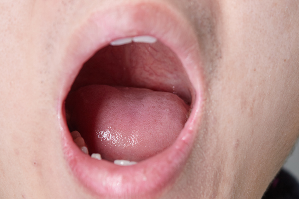 口臭严重是幽门螺杆菌引起的吗,有口臭是不是幽门螺杆菌引起的