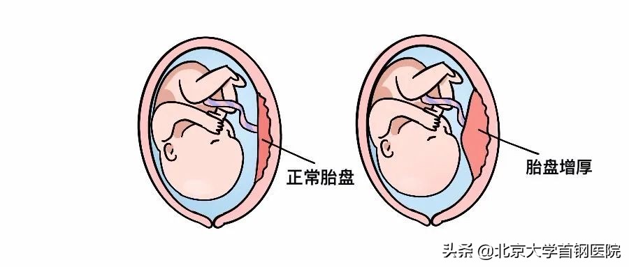 胎盘增厚是nt增厚吗,胎盘突然增厚会导致胎盘早剥吗