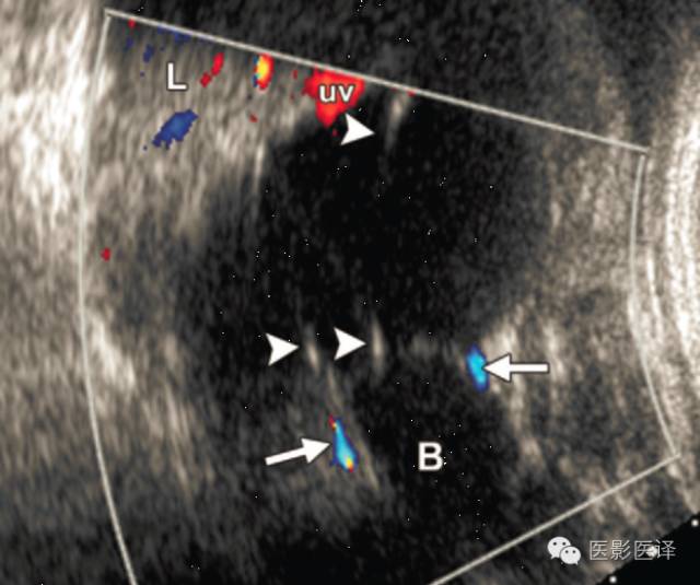孕期发现卵巢囊肿有8cm左右,孕19周查出胎儿卵巢囊肿