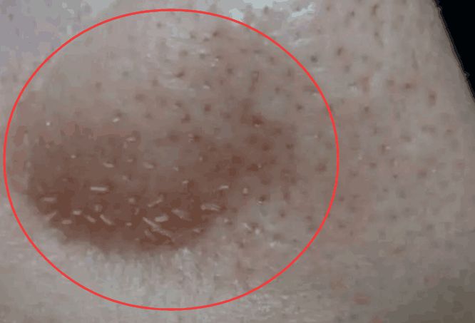 如何彻底消灭在痘痘里的螨虫,痘痘里面有米粒怎么全部去除