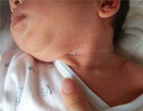 宝宝淹脖子需要怎么处理,宝宝淹脖子怎么办妈妈这样做