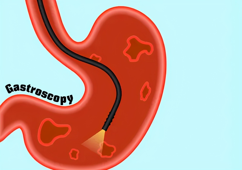 做胃镜无痛好还是普通胃镜好,做胃镜是无痛好还是普通胃镜好