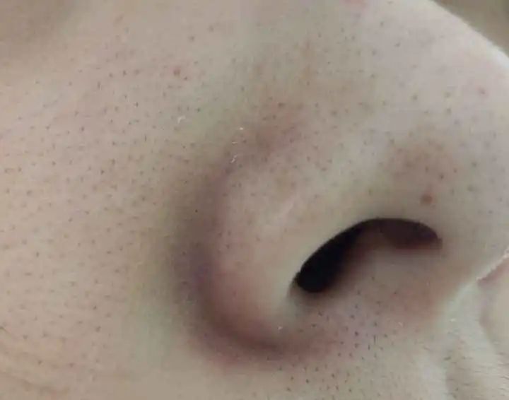 宋威龙、赵露思皮肤管理失败?毛孔粗大怎么办-四步改善毛孔粗大