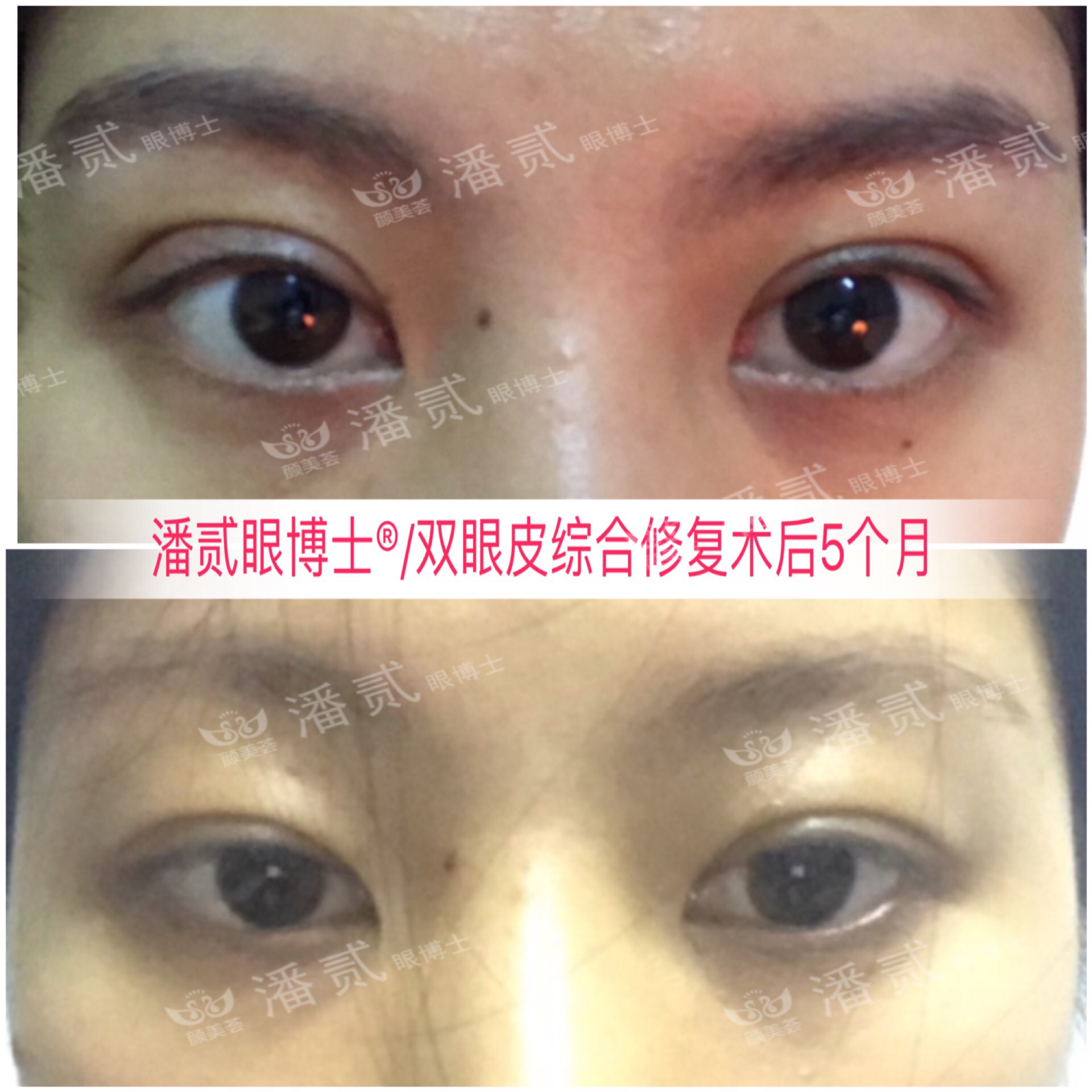 肿眼泡抽脂肪埋线双眼皮效果,肿眼泡割双眼皮长脂肪