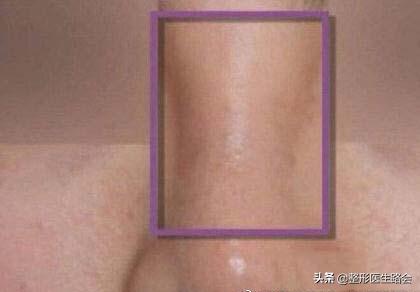 玻尿酸隆鼻副作用图片,玻尿酸隆鼻好不好优势有哪些