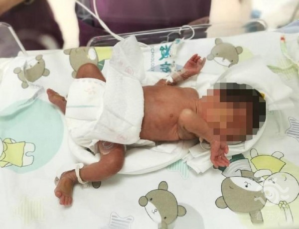 苏州超早产儿仅重1000多克！“小一千”闯关3个月，出院