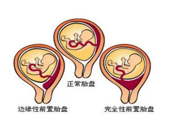 前壁好生还是后壁好生,前壁还是后壁好生