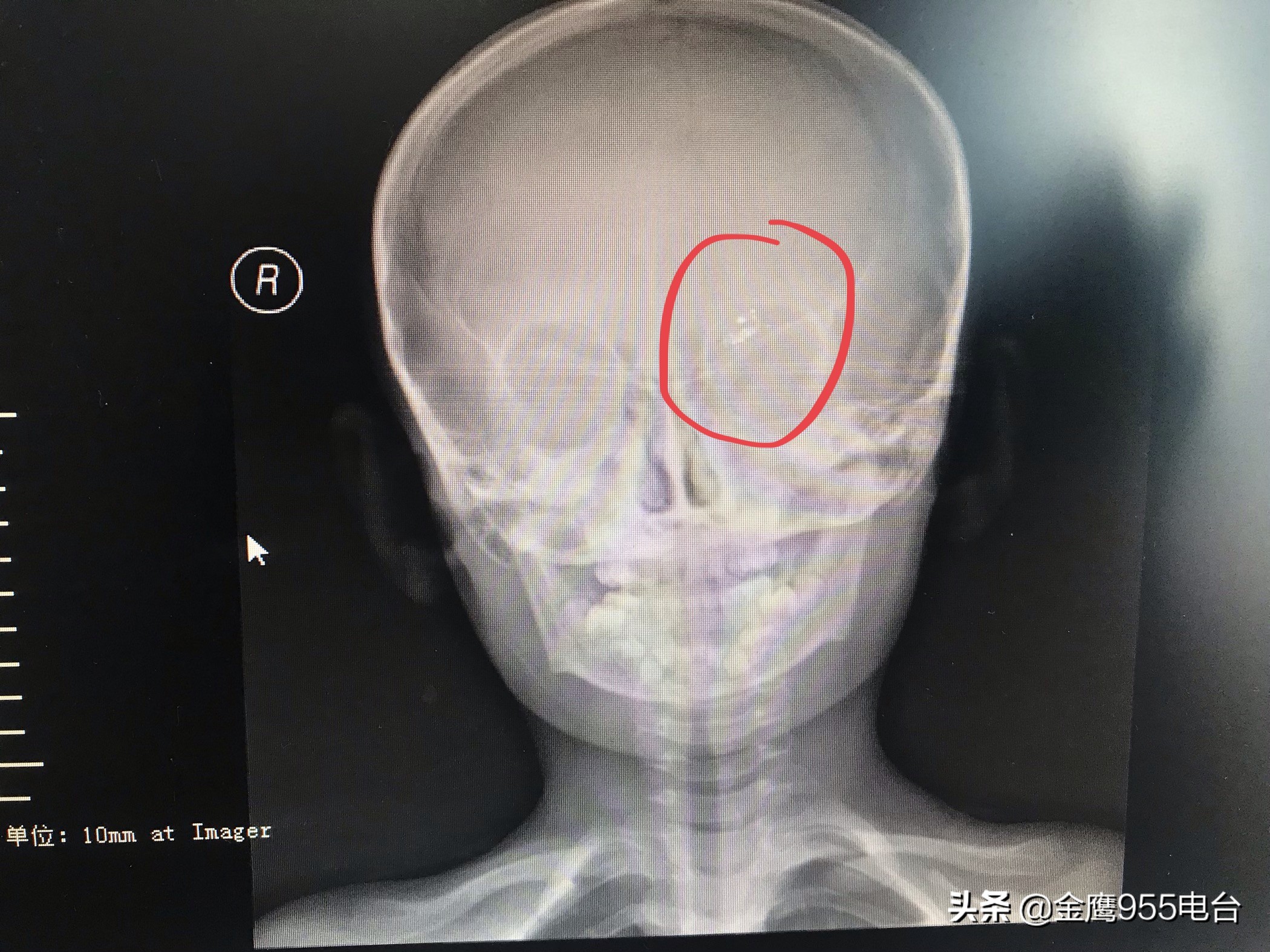 家长注意了！男孩不慎摔倒温度计插入眼眶三年驱汞治疗仍有残余