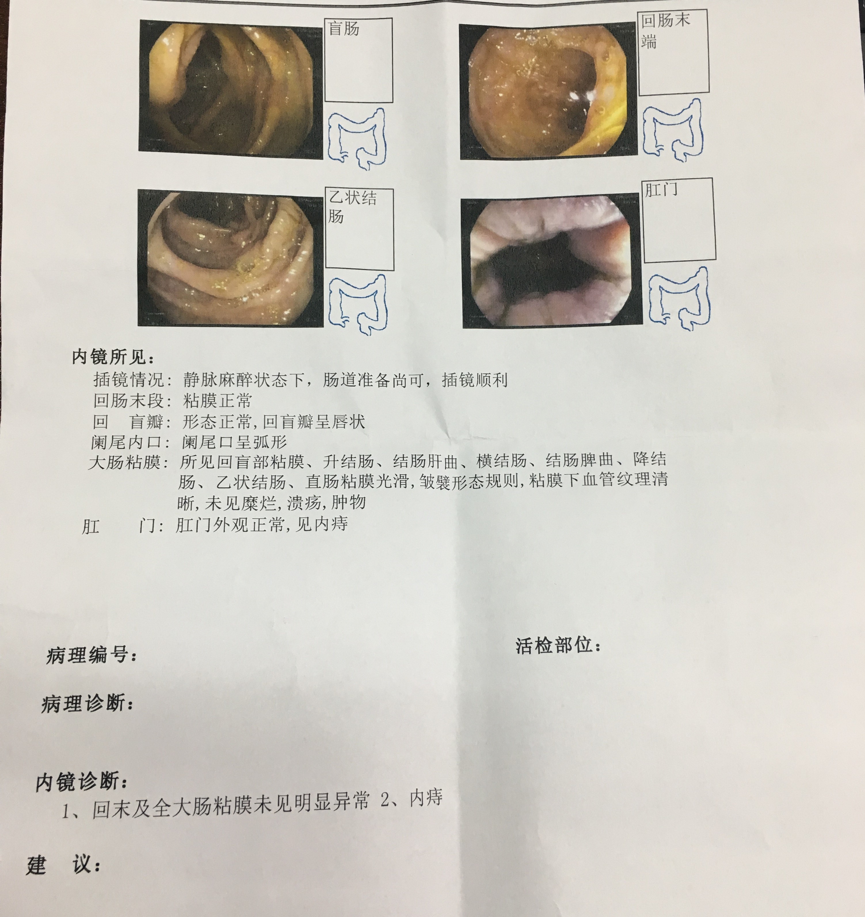 痔疮的健康讲座,痔疮严重怎么幽默说