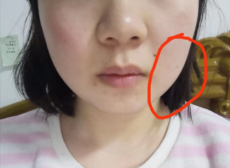 中药治疗腮腺炎、低热患者病案1例（1周）