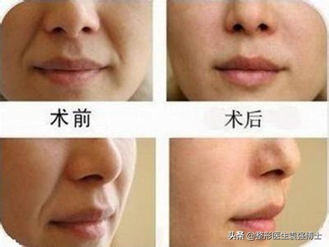 一招教你解决法令纹,这3种方法解决法令纹效果很惊艳