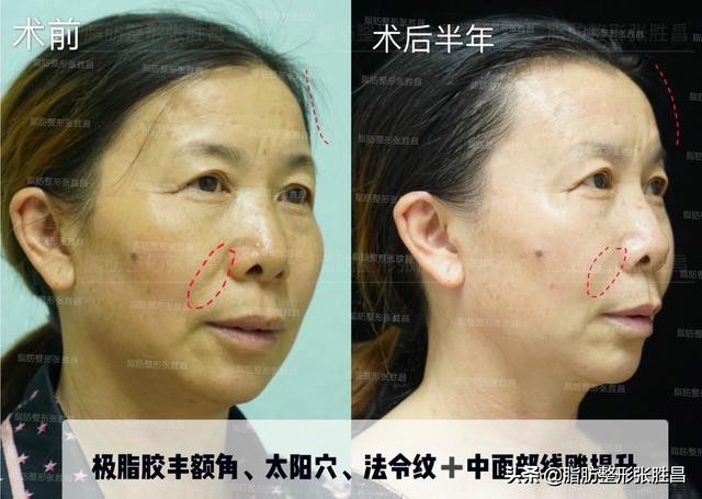 为什么我笑起来有皱纹,为什么我笑起来很显老