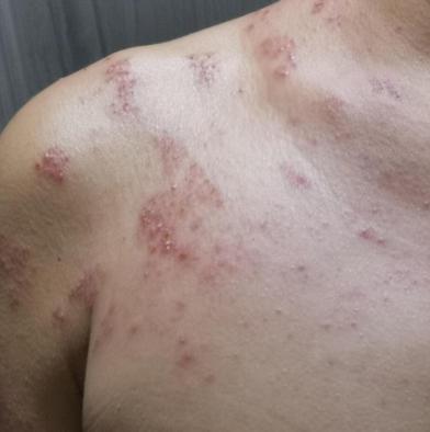 得了带状疱疹要及时就医,得了带状疱疹抹什么药好得快