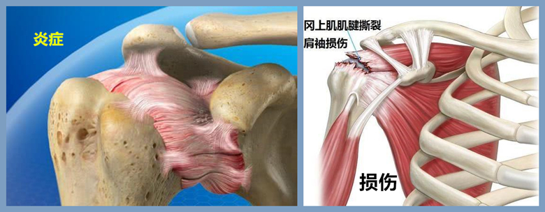 肩膀痛不一定就是肩周炎,肩周炎肩膀痛有什么好方法治疗