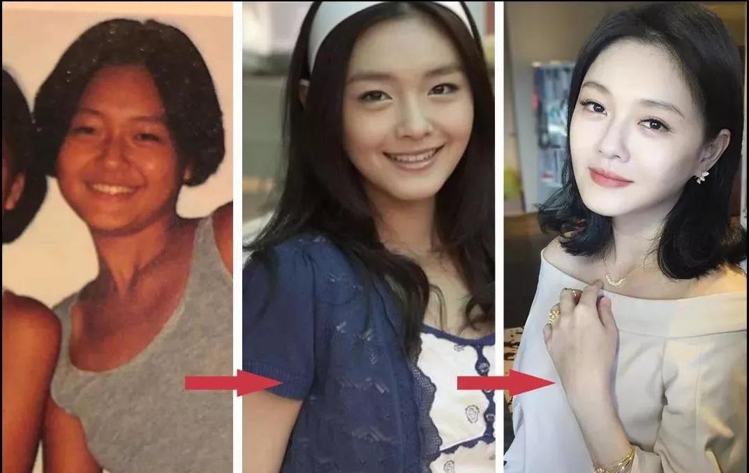 泰国美白针真实事件,女子连续打6年美白针