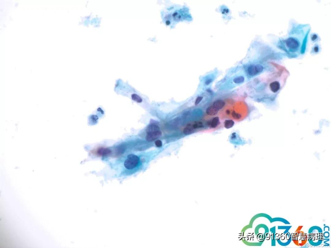 病理宫颈活检lsil是什么意思,宫颈病理检查与tct检查的区别