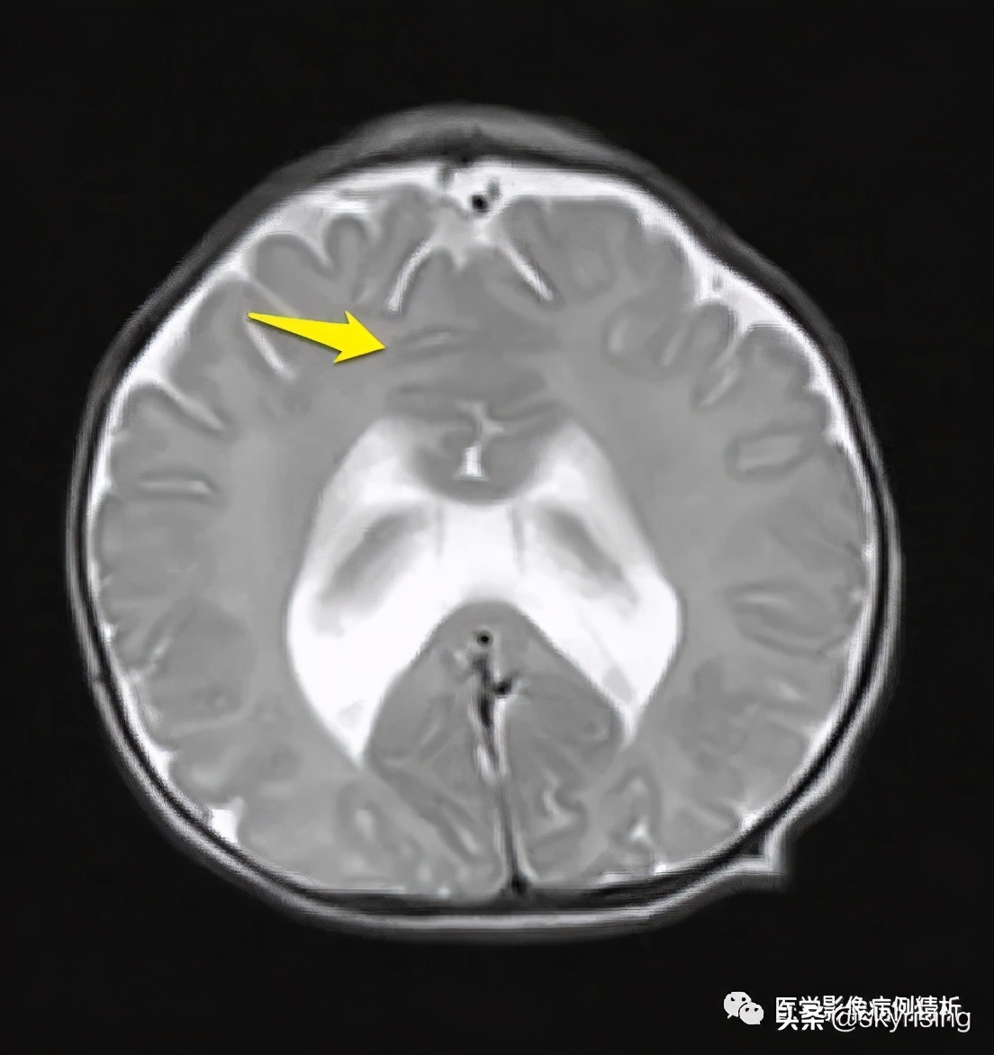 半叶全前脑畸形,无叶型前脑无裂畸形超声表现