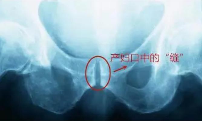 产后盆底肌修复训练一般做几个,产后盆底肌修复注意事项