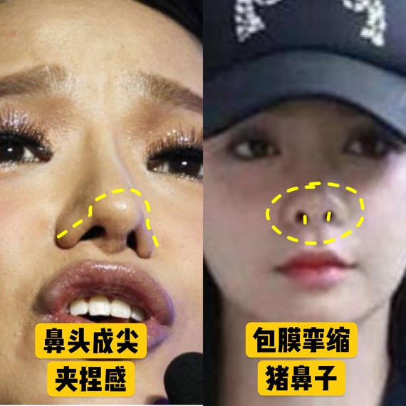 好看的鼻子类型驼峰鼻,好看的鼻型有哪几种