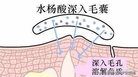 维a酸药膏治疗痘痘效果,中成药维a酸类口服药有哪些