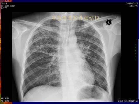 怀疑肺结核一定要查三次痰吗,医生怀疑是肺结核的几率有多大