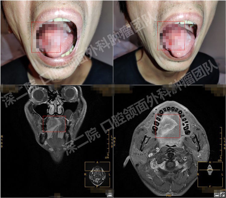 舌癌患者的守护神—深圳市第二人民医院口腔颌面外科肿瘤团队