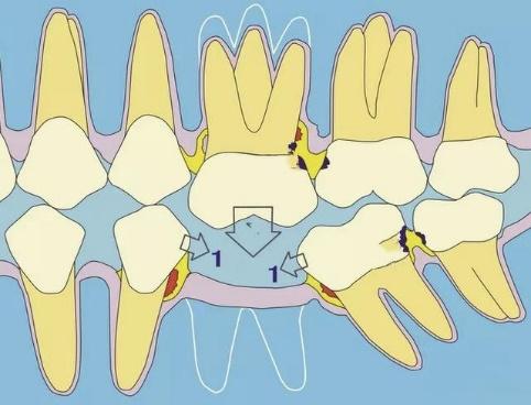牙齿变长了怎么解决,牙齿怎么变长了