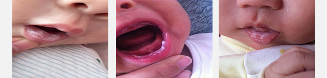 鹅口疮反反复复的怎么办,鹅口疮老是反反复复怎么办