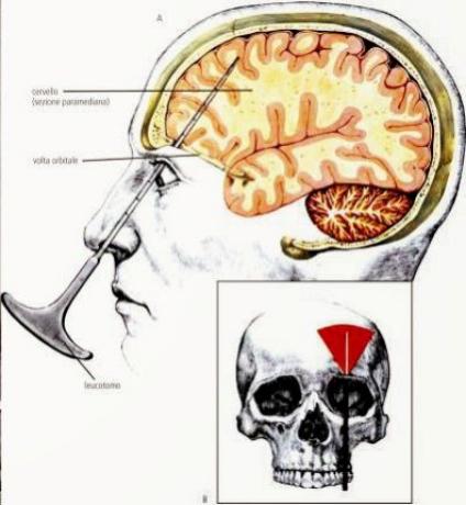 脑子裂开是什么样子,脑子裂开后会发生什么