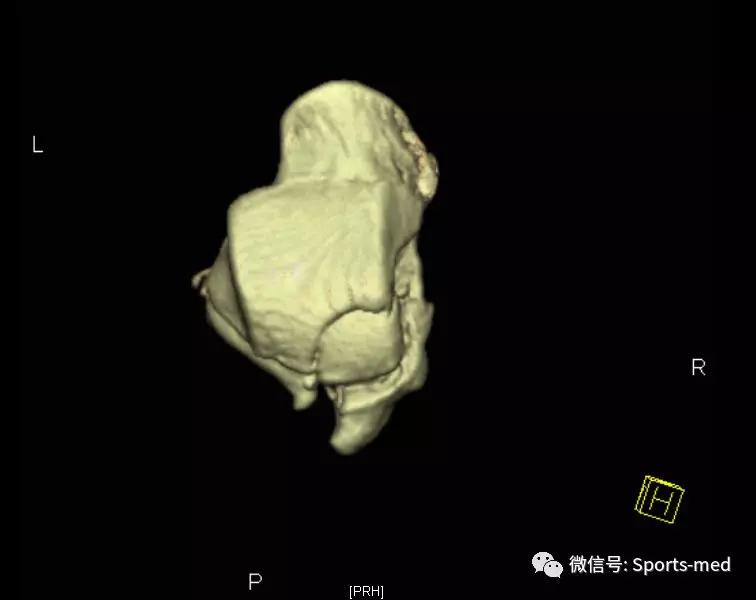 距骨软骨损伤的关节镜治疗,距骨软骨损伤关节镜手术