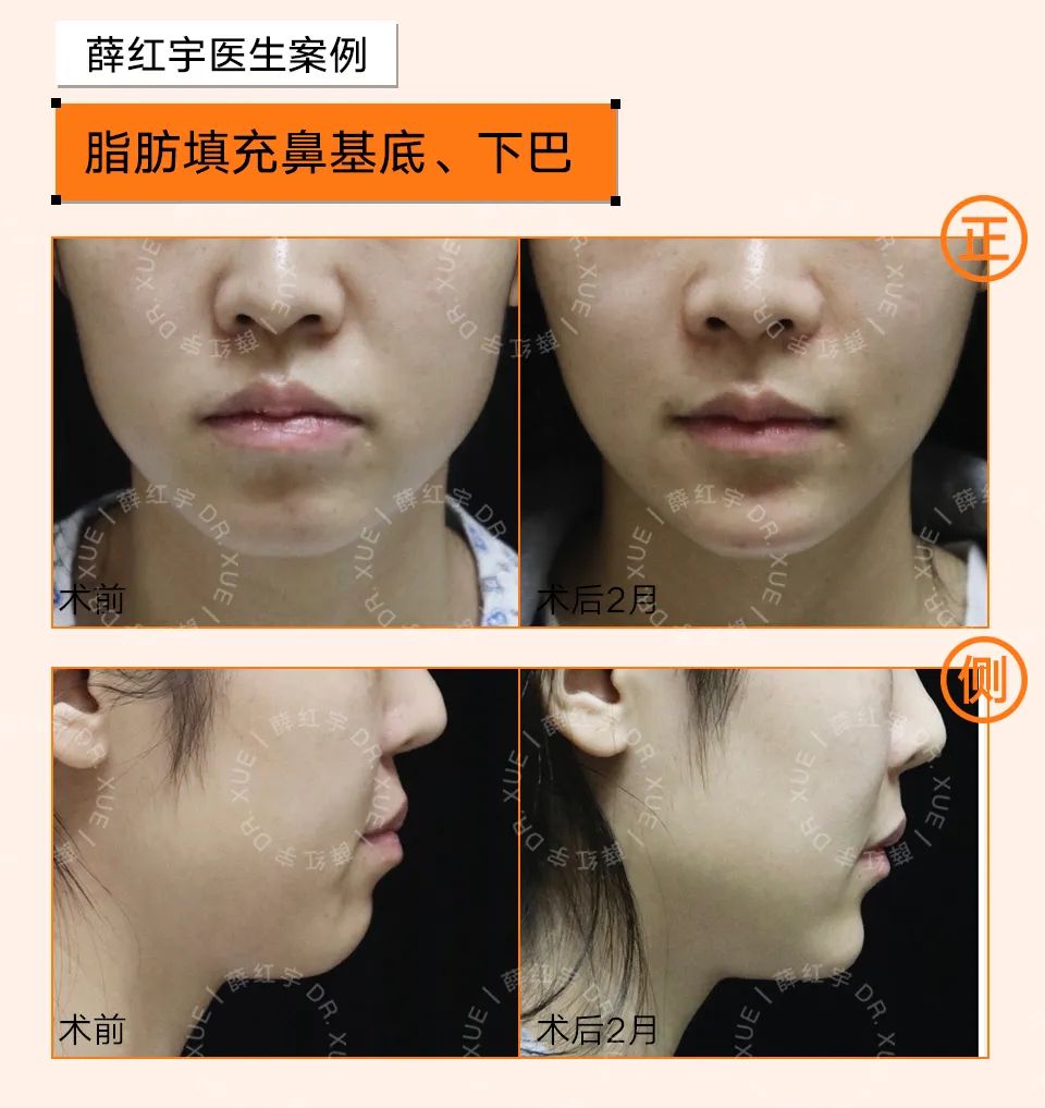 脾胃好了法令纹会改善吗,面部瑜伽能改善法令纹吗