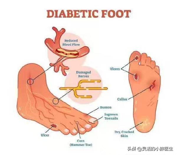 大叔糖尿病足,糖尿病足血管堵塞只能截肢吗