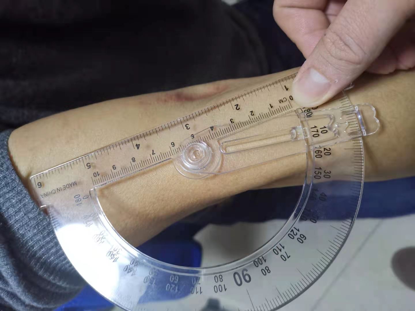 肘关节伸不直推拿正骨手法,李德明柔性正骨肘关节