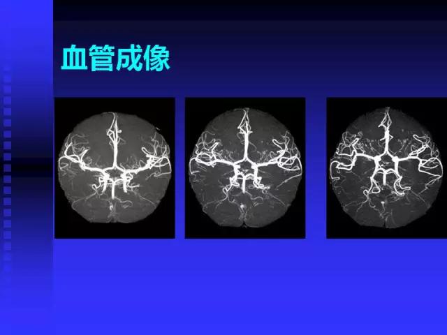 头颅mri读片视频教程,颅脑mri读片入门教程视频讲解全集