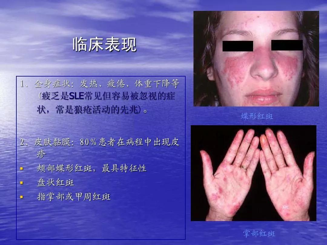 释疑解惑掀开羟氯喹的神秘面纱,氯喹和氯喹啉的作用