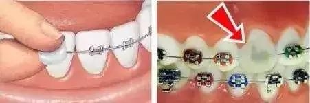 牙齿疼痛按摩哪里可以缓解,矫正牙齿打钢钉几天能缓解疼痛