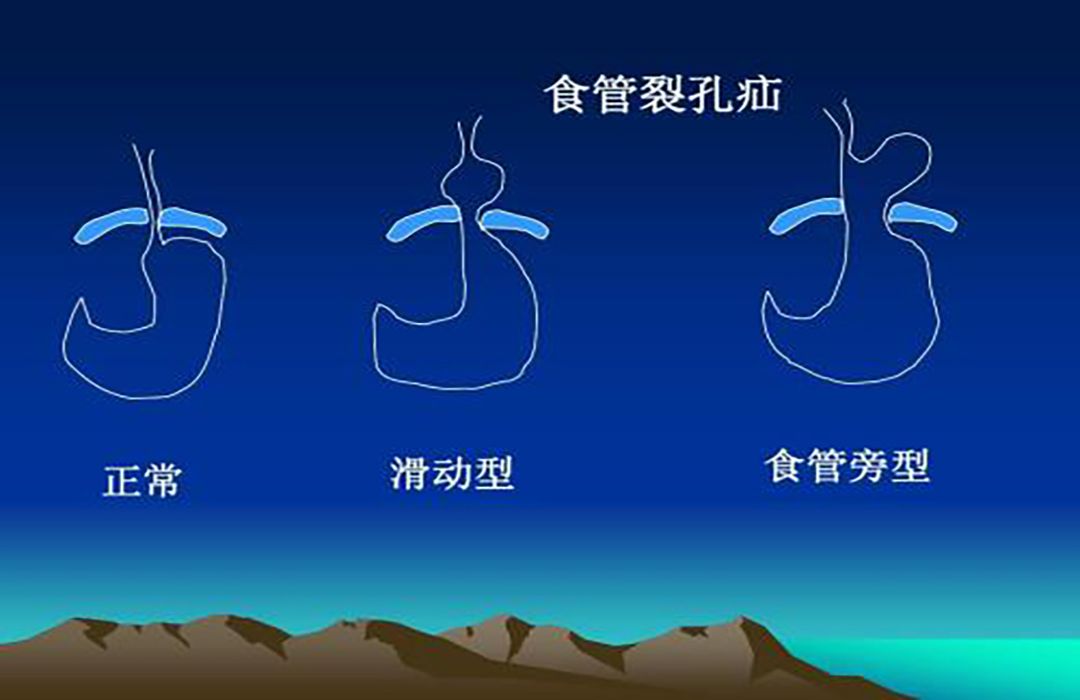 孕期疼痛有哪些如何缓解,孕期腰部以下臀部以上疼痛怎么办